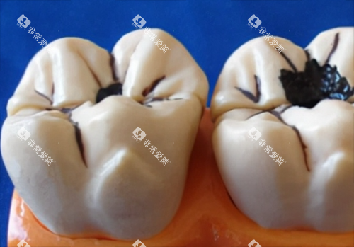 轻度和重度龋齿模型展示 轻度和重度龋齿模型展示