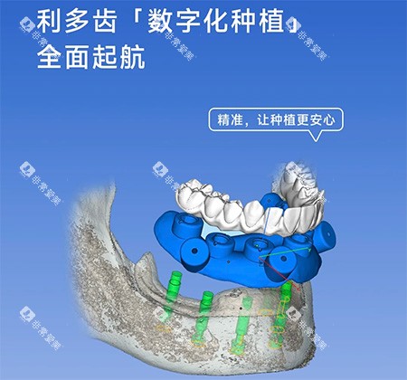 利多齿种植牙怎么样 利多齿种植牙怎么样