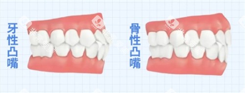 骨性凸嘴和牙性凸嘴
