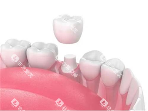 牙齿戴牙冠示意图