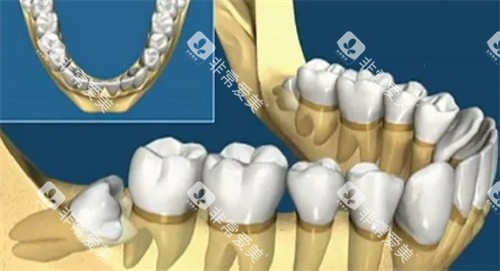 智齿牙齿动画图