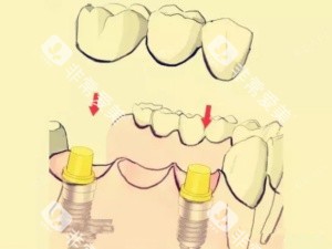 钛合金烤瓷牙漫画示意图