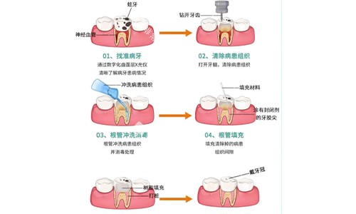 根管治疗的全过程示意图 根管治疗的全过程示意图