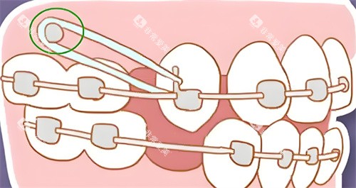 牙齿矫正卡通图片