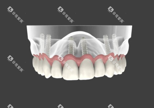半口种植牙模型图