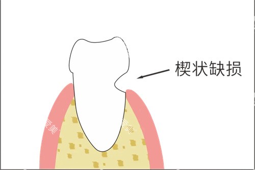 牙齿楔状缺损漫画示意图 牙齿楔状缺损漫画示意图