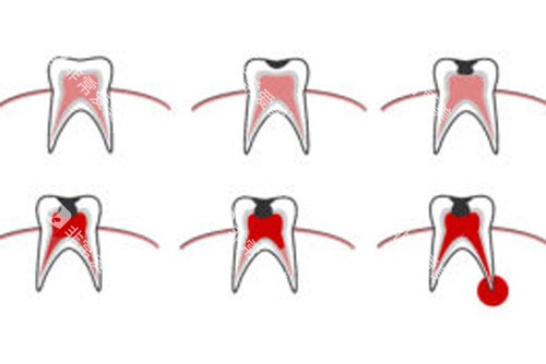 牙齿疼痛内部示意图 牙齿疼痛内部示意图