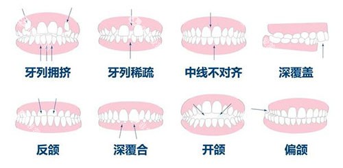 牙齿矫正正畸适应症 牙齿矫正正畸适应症