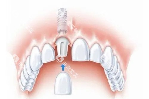 单颗种植牙安装牙冠卡通示意图