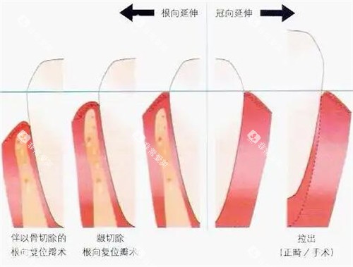 牙冠延长对比展示图