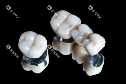 烤瓷牙冠模型图