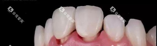 牙冠展示示意图