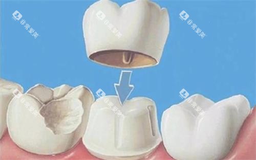 全瓷牙冠安装