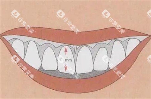 牙冠延长图片照片