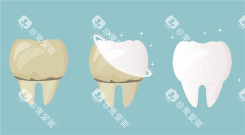 牙齿清洗前后对比
