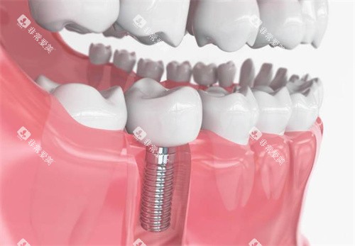 种植牙模型展示图片 种植牙模型展示图片