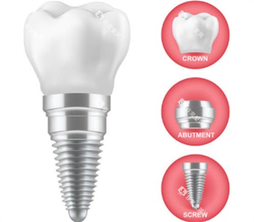 种植牙的三部分 种植牙的三部分