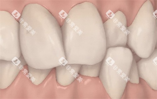 牙齿错颌拥挤 牙齿错颌拥挤
