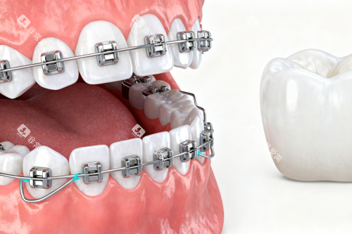 牙齿矫正卡通展示 牙齿矫正卡通展示