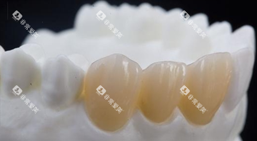 前牙全瓷冠展示 前牙全瓷冠展示