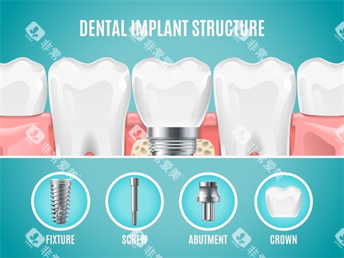 种植牙植体组成部分展示