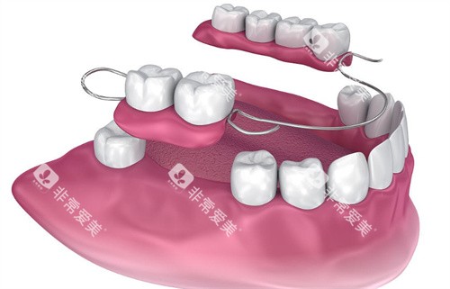 可移动部分假牙