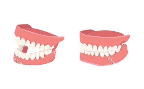 假牙示意图