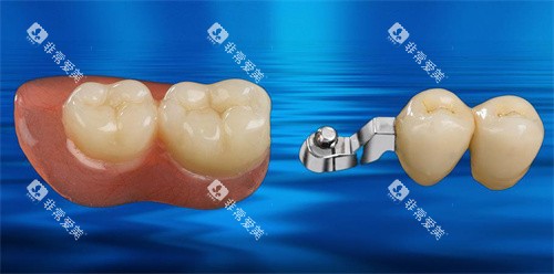 无挂钩假牙实物