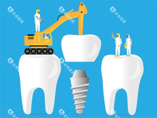 种植牙工程示意图
