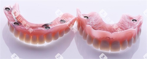 全口修复假牙