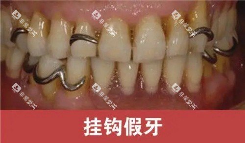 挂钩假牙展示示意图