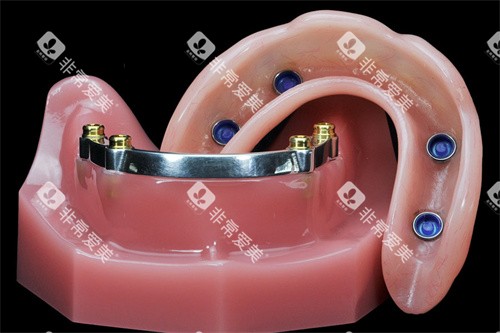 locator半固定种植牙修复种植体