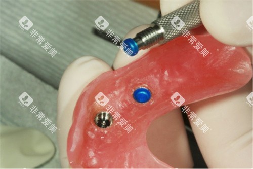 Locator半固定种植牙修复体配件