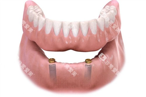 种植覆盖义齿Locator呈现图