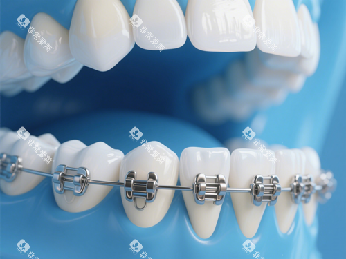 牙齿矫正示意图