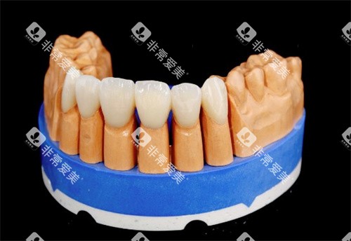 泽康二代全瓷牙