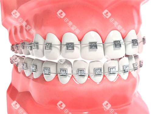牙齿矫正金属牙套漫画图