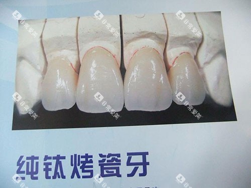 纯钛烤瓷牙模型展示图