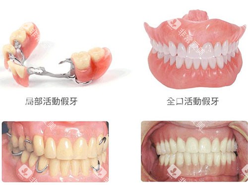 局部活动假牙和全口活动假牙示意图
