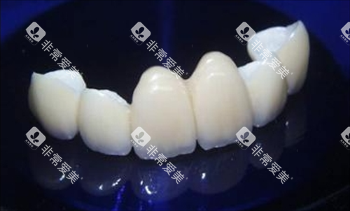 则武全瓷牙联冠展示