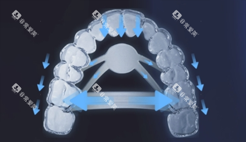 正雅隐形矫正s11牙齿位移变化