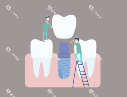种植牙检查示意图