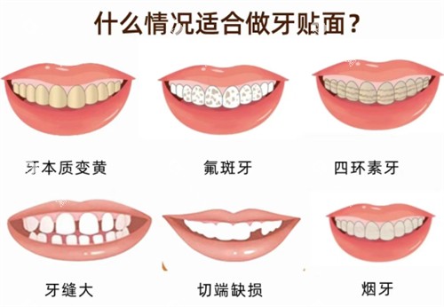 适合做牙贴面的情况