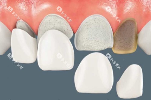 牙贴面卡通图片展示