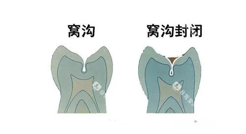 窝沟封闭前后的对比图