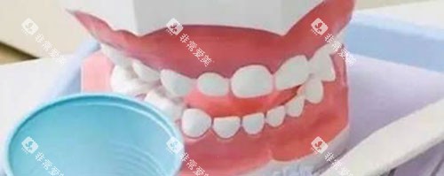 全口活动假牙展示