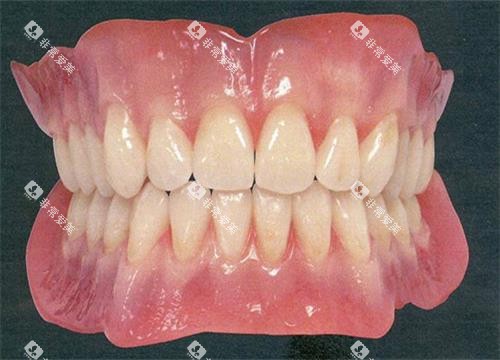 活动假牙全口示意图