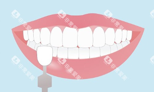 牙齿贴面示意图