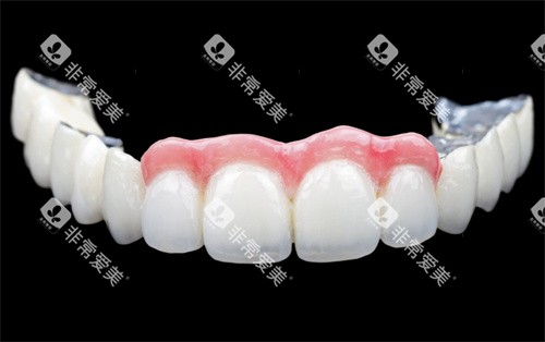 牙齿贴面展示jpg