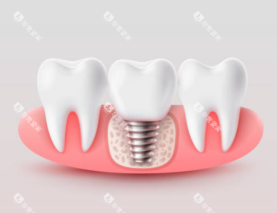 种植牙模型图示意图